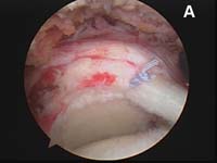 Rotator Cuff Tear. Arthroscopic view of rotator cuff repair. Margin Convergence Technique Rotator Cuff Tear. Arthroscopic view of rotator cuff repair. Margin Convergence Technique