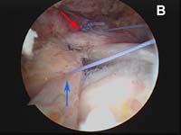 Rotator Cuff Tear. Arthroscopic view of rotator cuff repair. Margin Convergence Technique Rotator Cuff Tear. Arthroscopic view of rotator cuff repair. Margin Convergence Technique