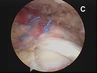 Rotator Cuff Tear. Arthroscopic view of rotator cuff repair. Margin Convergence Technique Rotator Cuff Tear. Arthroscopic view of rotator cuff repair. Margin Convergence Technique
