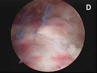 Rotator Cuff Tear. Arthroscopic view of rotator cuff repair. Margin Convergence Technique Rotator Cuff Tear. Arthroscopic view of rotator cuff repair. Margin Convergence Technique