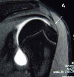 Rotator Cuff. MRI view of normal rotator cuff Rotator Cuff. MRI view of normal rotator cuff