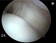 Rotator Cuff Tear. Arthroscopic view of normal rotator cuff Rotator Cuff Tear. Arthroscopic view of normal rotator cuff