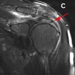 Rotator Cuff Tear. MRI view of moderately torn rotator cuff Rotator Cuff Tear. MRI view of moderately torn rotator cuff