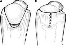 Rotator Cuff Tear. Margin Convergence Rotator Cuff Tear. Margin Convergence