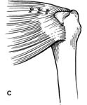 Rotator Cuff Tear. Margin Convergence Rotator Cuff Tear. Margin Convergence