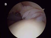 Rotator Cuff Tear. Arthroscopic view of partial thickness rotator cuff tear Rotator Cuff Tear. Arthroscopic view of partial thickness rotator cuff tear