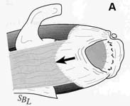 Rotator Cuff Tear. Diagramatic view of small- to medium-sized rotator cuff tear Rotator Cuff Tear. Diagramatic view of small- to medium-sized rotator cuff tear