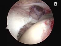 Rotator Cuff Tear. Arthroscopic view of small- to medium-sized rotator cuff tear Rotator Cuff Tear. Arthroscopic view of small- to medium-sized rotator cuff tear