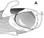 Rotator Cuff Tear. Diagramatic view of massive rotator cuff tear. Rotator Cuff Tear. Diagramatic view of massive rotator cuff tear.