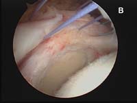 Rotator Cuff Tear. Arthroscopic view of massive rotator cuff tear Rotator Cuff Tear. Arthroscopic view of massive rotator cuff tear