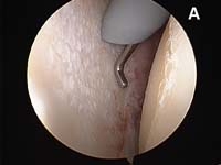 Rotator Cuff Tear. Arthroscopic view of arthritic shoulder Rotator Cuff Tear. Arthroscopic view of arthritic shoulder