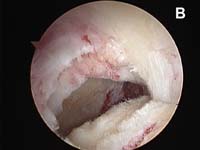 Rotator Cuff Tear. Arthroscopic view of arthritic shoulder Rotator Cuff Tear. Arthroscopic view of arthritic shoulder