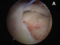 Rotator Cuff Tear. Arthroscopic view of rotator cuff repair Rotator Cuff Tear. Arthroscopic view of rotator cuff repair