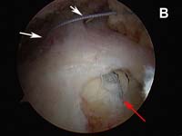 Rotator Cuff Tear. Arthroscopic view of rotator cuff repair Rotator Cuff Tear. Arthroscopic view of rotator cuff repair