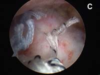Rotator Cuff Tear. Arthroscopic view of rotator cuff repair Rotator Cuff Tear. Arthroscopic view of rotator cuff repair