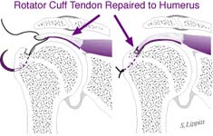 Fig. 14 Rotator cuff tendon repaired to humerus