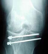 Fig. 5 - This patient had rheumatoid arthritis and symptoms throughout her knee resulting in the traditional total knee replacement pictured here.