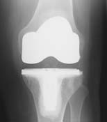 Fig. 6 - This patient's arthritis was confined to the medial (inside) compartment of her knee on x-rays and her pain was localized to that part of the knee as well. She was a good candidate for minimally-invasive partial knee replacement.