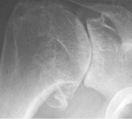 Figure 6: Anteroposterior x-ray of an arthritic shoulder