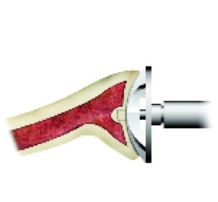 Figure 3: Reaming the glenoid.